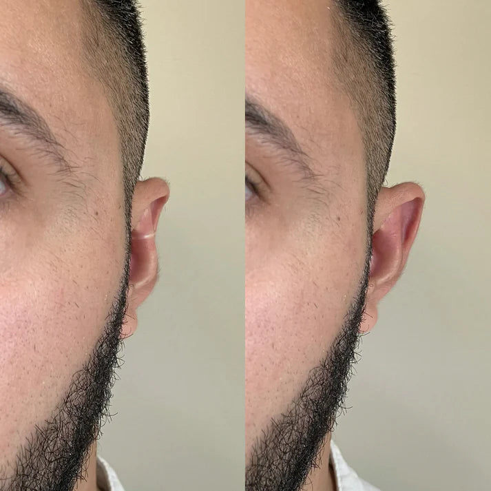 Tuckies™ Ear Aligners